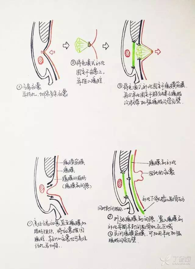 全国疝气治疗新进展