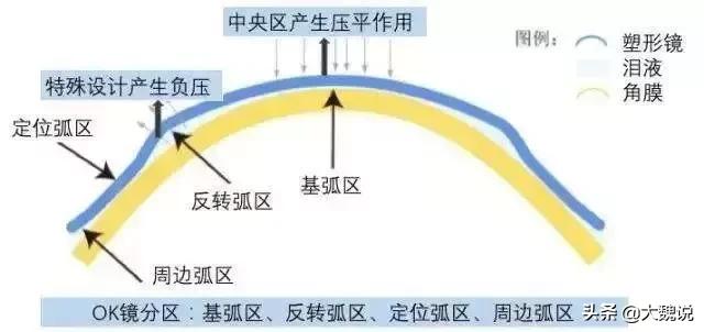 近视最新进展